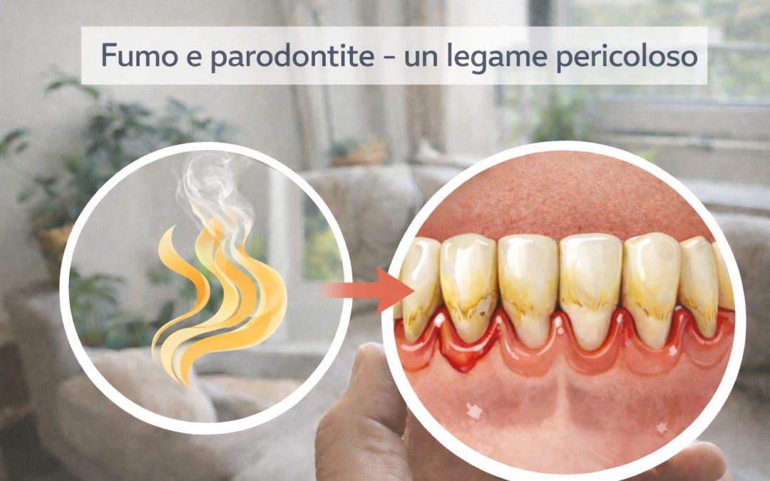 Fumo e parodontite: un rischio serio per la salute delle gengive