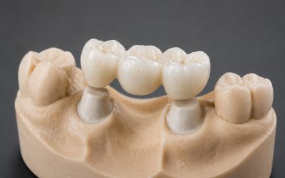 Quanto può durare un ponte dentale?