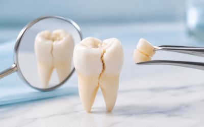 Dente rotto: intervenire subito può fare la differenza